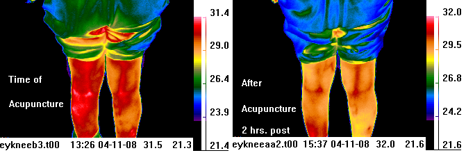 infrared image
                            before & after acupuncture